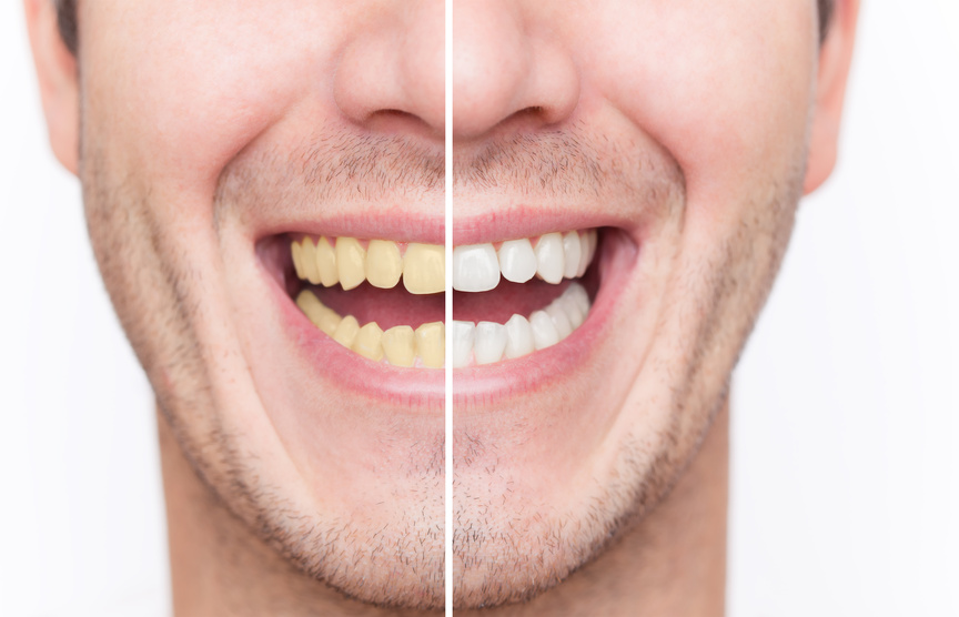 Zahnbleaching und andere ästhetische Zahnbehandlungsmethoden