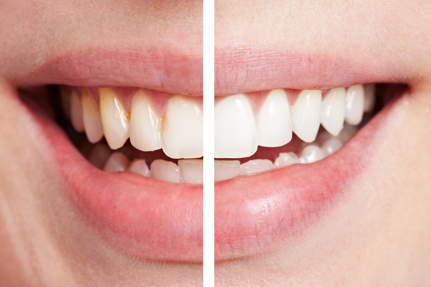 Zahnbleaching und andere ästhetische Zahnbehandlungsmethoden